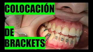 COLOCACIÓN DE BRACKETS CONOCE EL PROCEDIMIENTO [upl. by Nitnelav]