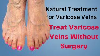 Natural Treatment for Varicose Veins on Legs  Get Rid of Varicose Veins [upl. by Inatirb985]