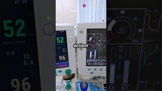 PRVC Mode in Ventilators Explained in 60 Seconds [upl. by Ielhsa]