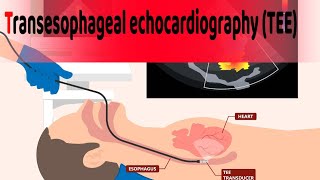 Transesophageal echocardiography TEE is a heart test understand what how amp when its doctors use [upl. by Mandell]