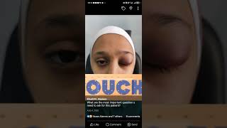 trauma to the eyelid VS cellulitis [upl. by Khichabia]