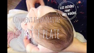 Comment reconnaitre une déformatione crânienne du bébé plagiocéphalie  brachycéphalie  tête plate [upl. by Oimetra]