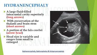 Hydranencephaly fluid filled fetal brain differentials  A2Z of Ultrasound [upl. by Aliahs]