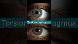 torsional nystagmus👀optoversedubai4066 optometrywithsamir optometrysolutionsoptometrists [upl. by Assened]