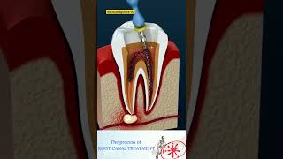 😱shorts 🪥Root Canal Treatment amp Tooth Absces dentalcare viraltrending neet neet2025 neet2026 [upl. by Cesar]