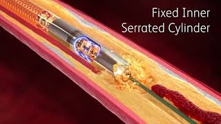 Rotarex™ Rotational Excisional Atherectomy System [upl. by Eniamraj]