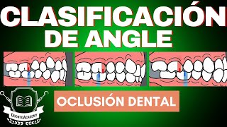 CLASIFICACIÓN DE LAS MALOCLUSIONES  CLASIFICACIÓN DE ANGLE  oclusión dental [upl. by Nezah533]