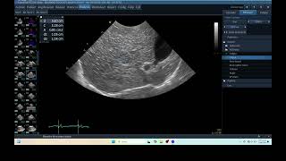 IQ 276 LIVER HEPATOMA PDH ULTRASOUND ECHOPAC ANALYSIS [upl. by Amihsat]