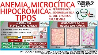 ANEMIA MICROCÍTICA HIPOCRÓMICA TIPOS  GuiaMed [upl. by Alba]