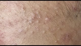 Squeezing blackheads on the forehead HoangMySpa70 [upl. by Sudnac]