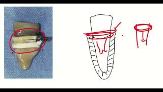 Rubber Band Extraction Technique for Dental Surgery in Patients with Bleeding Disorders ASPIRE MDS [upl. by Esiled]