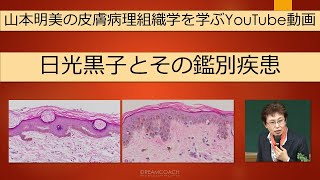 日光黒子とその病理組織学的鑑別疾患 dermatopathology 山本明美 lentigo [upl. by Etnuahc474]