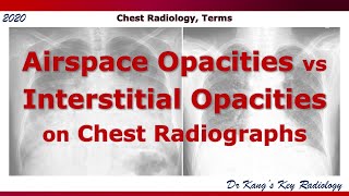 Airspace vs Interstitial Opacities Terms [upl. by Leroy]