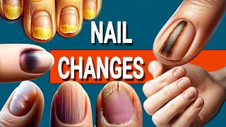 13 Nail Changes and What They Mean for Your Health [upl. by Banyaz]