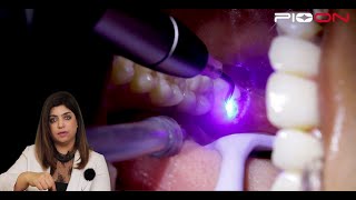 Excision of soft tissue Operculectomy by Pioon S1 Dental Diode Laser [upl. by Carilla]