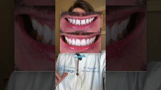 Faccette in Ceramica a Bari  Miglior Dentista Bari bari invisalign puglia dentista [upl. by Namreh52]