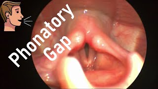 Phonatory Gap or Glottal Gap What are the Aetiologies How to Treat [upl. by Nospmis]