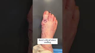 Elder Patients Fixed Bunion amp Hammertoe 😮 [upl. by Aelak550]