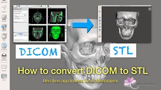 How to convert DICOM file to 3D printable STL file [upl. by Davida]