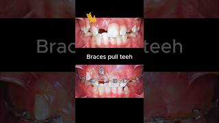 Braces for impacted tooth braces orthodontist dentist dentisty [upl. by Mckenzie]