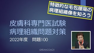 皮膚科専門医試験問題の解説 2022年度問題100 [upl. by Allimrac878]