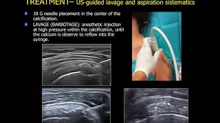 echoguided lavage of the calcific tendinitis of the shoulder [upl. by Enalda677]