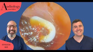 GROMMET REMOVAL FROM EAR CANAL EP853 [upl. by Esteban151]