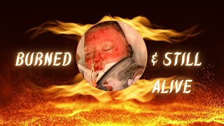 Burned Alive Ron Spencer’s 17Year Journey of Miraculous Healing and Ministry [upl. by Kizzie227]