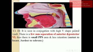 Posterior palatal seal part 1شرح [upl. by Any]