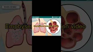 Emphysema animation video shorts animationScience biology india nucleusmedicalmedia [upl. by Leeland]