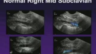 Upper Extremity Venous Exam Technique and Interpretation [upl. by Htebazil]