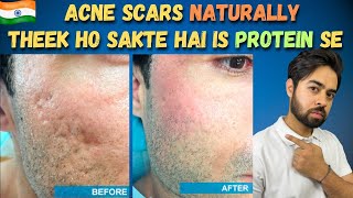 Remove Acne Scars Naturally  3 Remedies 100 Works With Results [upl. by Ahsilrae]