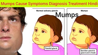 Mumps Cause Symptoms Treatment in Hindi  Cause of Mumps Symptoms of Mumps What is Mumps Mumpa [upl. by Galatea]