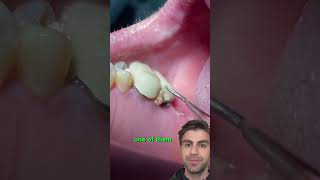 How do cavities get under crowns dentist teeth tooth crown [upl. by Otreblasiul998]