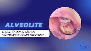 ALVEOLITE complicação PÓS OPERATÓRIA saiba quais são os sintomas e como prevenir [upl. by Malinda]