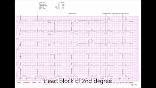 The ECG Song  ECG version [upl. by Acinomed]