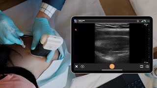 Suprascapular Nerve Block [upl. by Mure994]