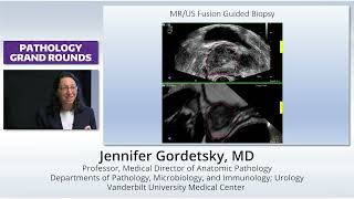 Established and Emerging Prognostic Markers in Prostate Pathology [upl. by Siraj]