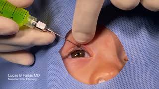 Probing of Nasolacrimal Duct with Fluorescein Irrigation [upl. by Grete]