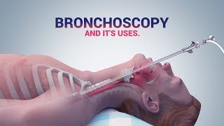 BRONCHOSCOPY  ITS USES I DR NAVEEN KUMAR AILAWADI I CHEST SPECIALIST [upl. by Esinad285]