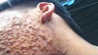 Big Cystic Acne Blackheads Extraction Blackheads amp Milia Whiteheads Removal Pimple Popping [upl. by Eerak]