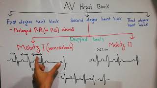 CVS physiology 49Second degree heart blockMobitz type 1Wenckebachamp Mobitz type 2 Dropped beats [upl. by Ruggiero96]