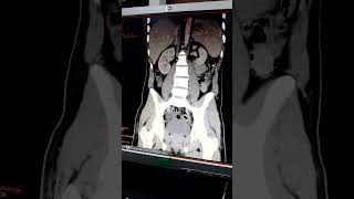 ctscan radiography photo venous phase ct [upl. by Baiel]