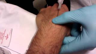 Ganglion cyst Aspirationremoval done right [upl. by Buzzell94]