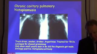 Diagnosis and treatment of chronic pulmonary aspergillosis [upl. by Kareem]