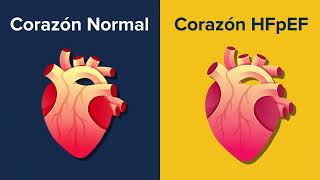 Estudio clínico para aprender más sobre HFpEF falla cardiaca e identificar futuros tratamientos [upl. by Juni]