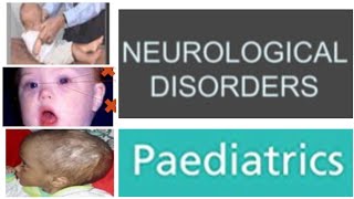 5 Neurological Disorders Paediatrics  Tuberculous Meningitis [upl. by Acirrehs]