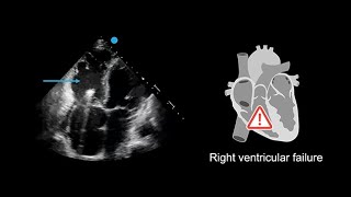 Recognizing poor right ventricular systolic function in echocardiography [upl. by Leaj993]