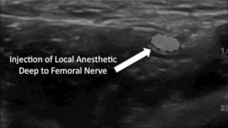 Ultrasound Guided Femoral Nerve Block [upl. by Warder]