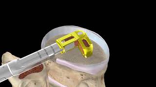 CoreLink Surgical FLXfit15 Spinal Device Implantation [upl. by Yrreiht]